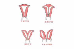 子宫畸形并非不能做试管，分析不同年龄女性手术成功率！