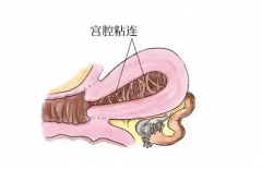 科普宫腔粘连治疗方法，哪些原因导致宫腔粘连？
