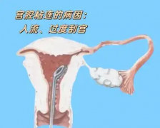 宫腔粘连容易导致女性不孕，预防有这些方法！