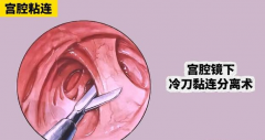 一文读懂宫腔粘连，怎么治疗看完就清楚了！