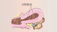 什么是宫腔粘连？得病以后后果有多严重？