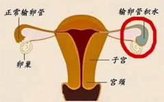 盘点输卵管积水危害，不只是影响女性生育能力！