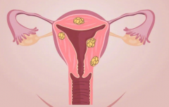 子宫肌瘤患者看过来：子宫肌瘤对女性有哪些危害？