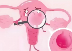 哪些原因引发子宫肌瘤？子宫肌瘤有什么症状？