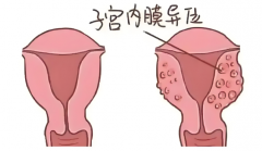 子宫内膜异位症怀孕难？这些方法或能助你一臂之力！
