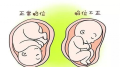 一文读懂胎位不正，6种常见异常胎位盘点！