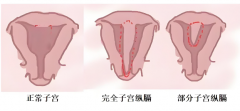 纵隔子宫做试管婴儿，着床成功率会受影响吗？详解在此！