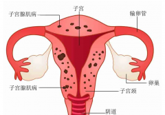 子宫腺肌症患者也有希望怀孕，几种治疗方法科普！