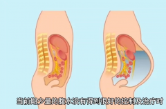 胚胎移植成功出现腹水，什么时候可以自然痊愈？