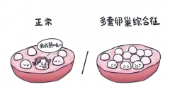 多囊卵巢患者如何高效促排卵？听听过来人的成功心得！