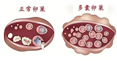 多囊备孕有妙招：三大策略助你跨越生育障碍！