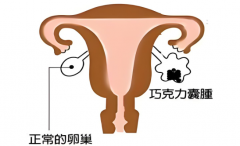 双侧巧克力囊肿生育难怎么办？掌握这些技巧提升一代试管成功率！