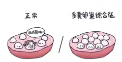 多囊卵巢综合症患者能否进行试管婴儿？全面解析在此！