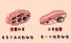 多囊做试管前必看！3招快速调理法，成功率大幅提升！