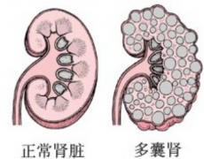 2025年上海长征医院多囊肾试管婴儿费用曝光，三代试管费用全解析