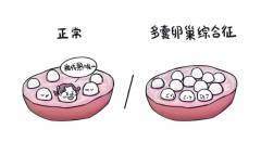 多囊女性选择人工授精成功率有多高？一文读懂！