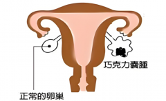 巧囊备孕必备：子宫内膜修复术+卵子质量提升法，双重保障成功受孕！