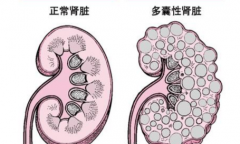 成都多囊肾试管婴儿全攻略：医院、费用、成功率一次看懂！