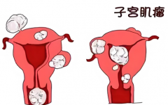 子宫肌瘤何时需手术？揭秘关键抉择的考量因素！