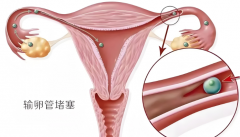 输卵管梗阻生育困境：治疗还是试管，何去何从？