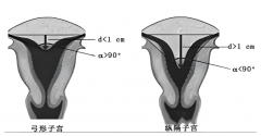 弓形子宫患者必看：这种子宫畸形，为何让医生都头疼？