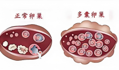 多囊双胎热议：促排药是“神助攻”还是“高风险陷阱”？
