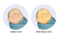 早产儿黄疸“大揭秘”：症状识别与应对全攻略！