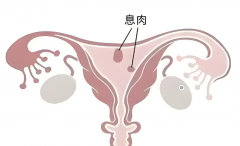 西安有宫颈息肉想做试管？这份风险、准备清单请收好！
