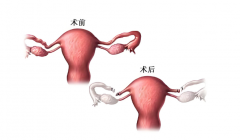 输卵管结扎后还能生吗？复通、自然受孕与试管费用解析？