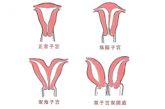 子宫畸形VS正常子宫：试管成功率差30%？科学策略如何缩小差距？