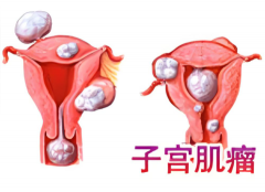 子宫肌瘤8cm还能做试管怀孕吗？这些方法帮你圆“妈妈梦”！
