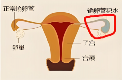 输卵管积水做试管能成功吗？过来人分享4个避坑秘诀，成功率翻倍！